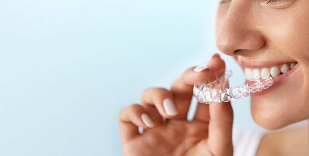 Clear Aligners