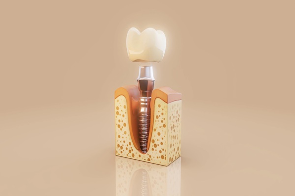 How Natural Does An Implant Crown Look?